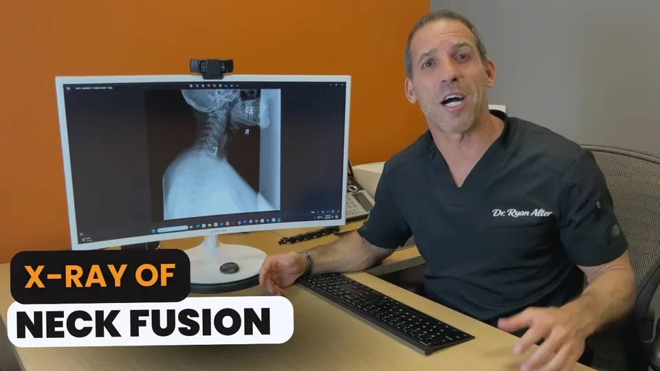 X-Ray of Neck Fusion Surgery