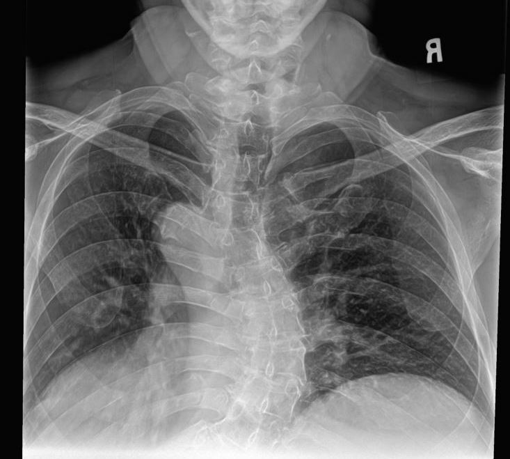 xray result of patients untreated scoliosis